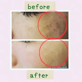 フォトフェイシャル【小田原・エステ・お顔ケア】