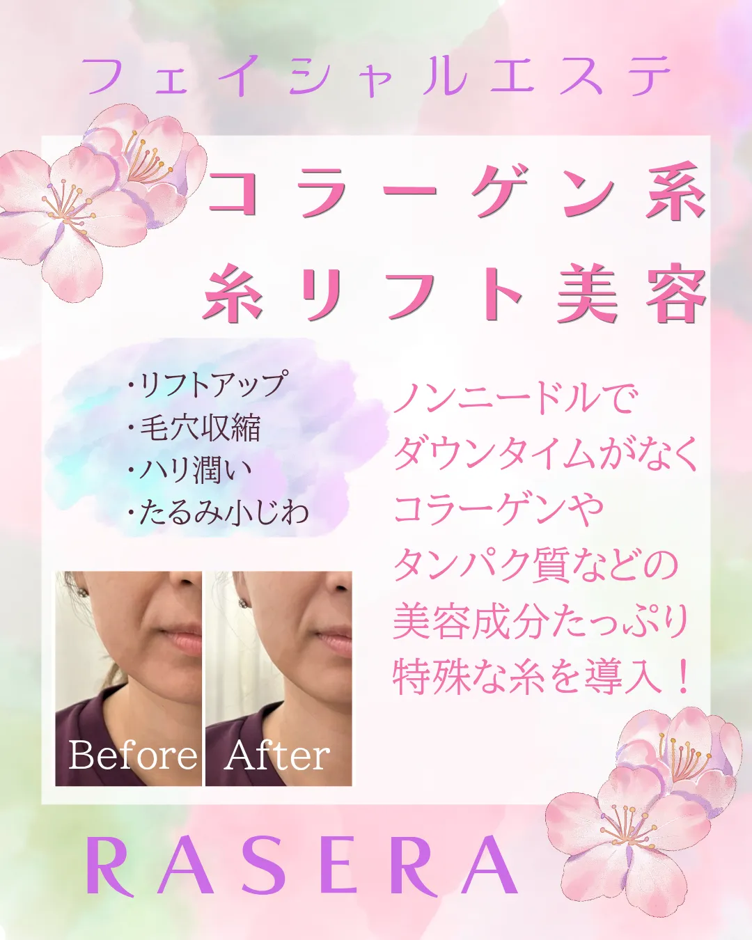 コラーゲン糸リフト美容♪【小田原・エステ・リラク】