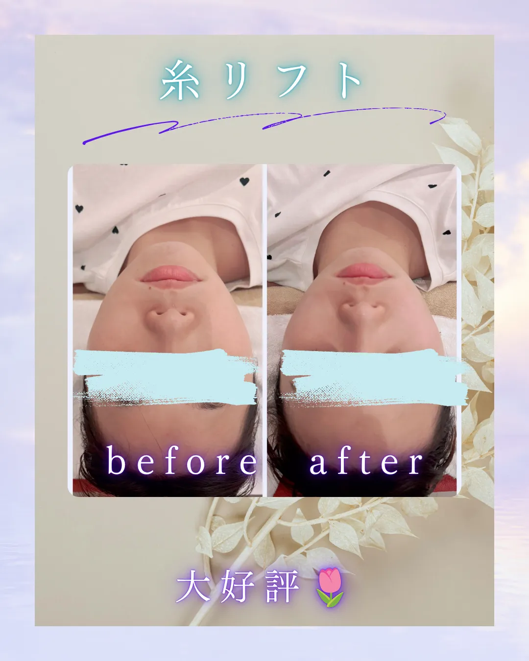 糸リフトケア【小田原・エステ・リフトアップ】